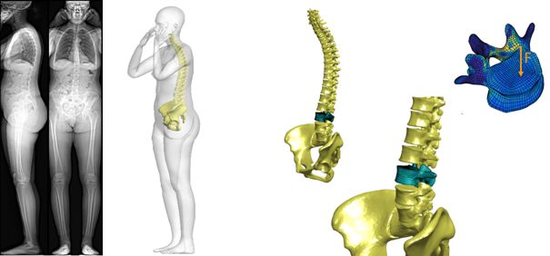 Fabrication d'implants